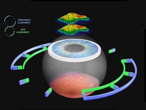 Eye Laser Technology